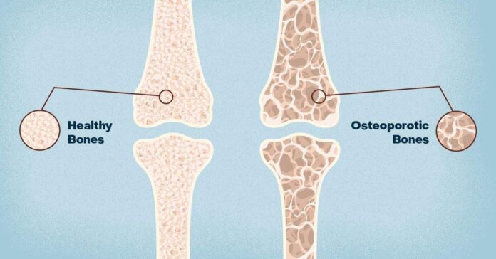 Osteoporosis